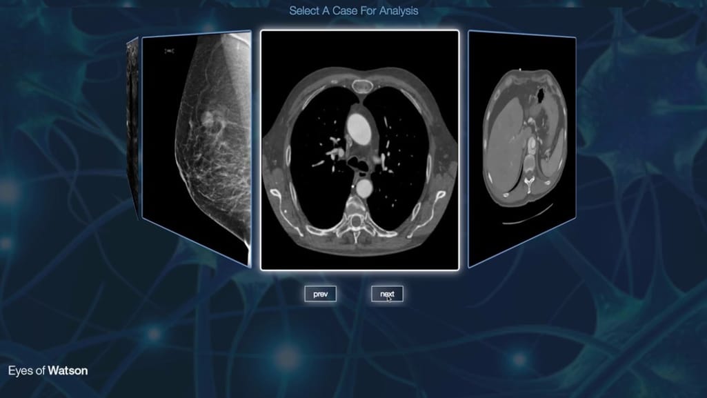 IBM researchers bring AI to radiology